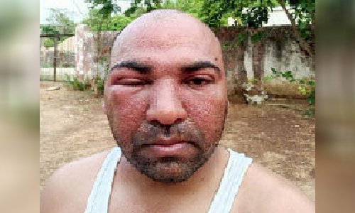 क्वारेंटाइन सेंटर में ये कैसी व्यवस्था ? जहरीले कीड़े के काटने से लोग परेशान, फिर भी सुध लेने वाला कोई नहीं